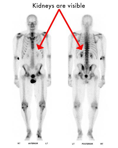 Normal bone scan with kidneys visible